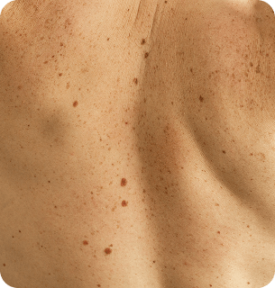 профилактике осложнений — трофических язв, тромбозов, пигментации кожи